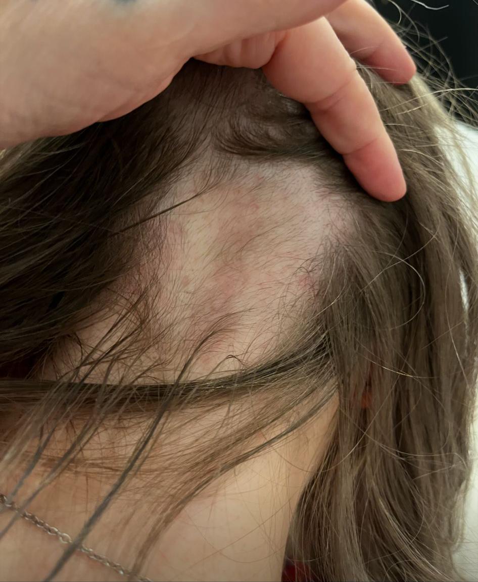Hair Loss Treatment for Women
